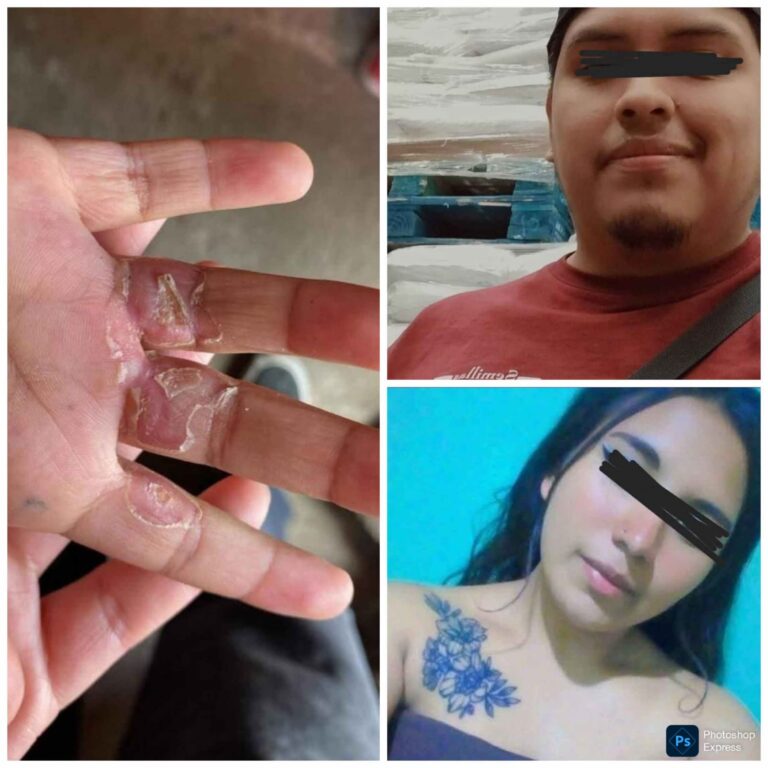 Padrastro quema las manos a dos niños de 6 y 4 años